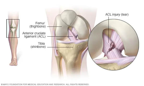 anatomía de una lesión de distensión de ligamentos de rodilla