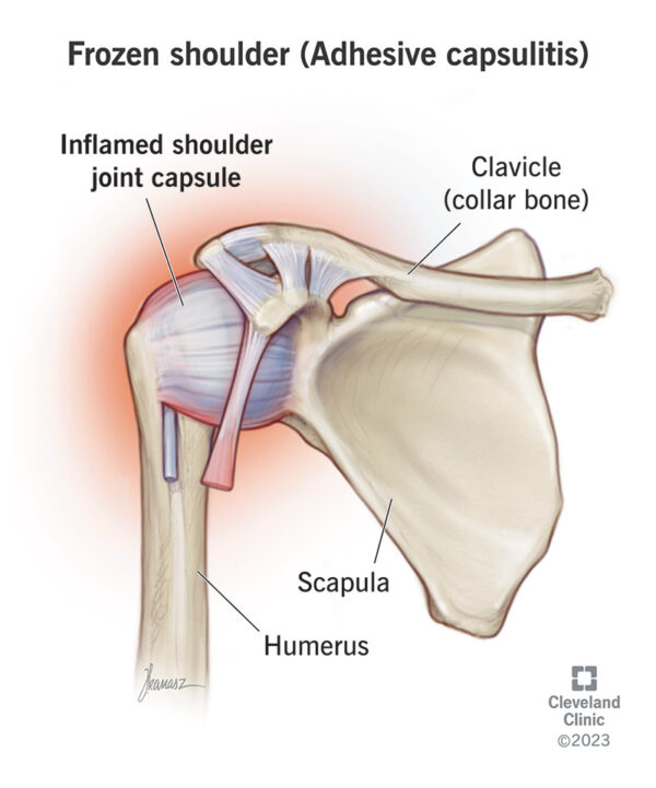 anatomia de la capsulitis adhesiva de hombro